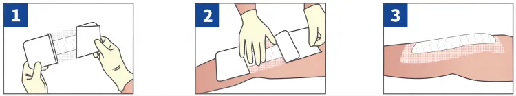 Silicone Post-Op Dressing Instructiosn for Use Silicone Post-Op Dressing Instructiosn for Use